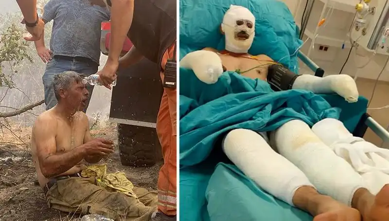 Orman Yangını Faciasında "Yanıyorum" Diye Feryat Eden İşçinin Hayatı Tehlikede