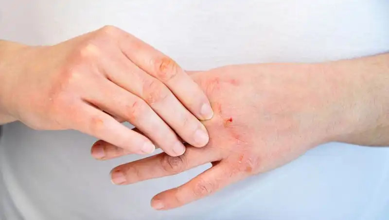Yetersiz Protein Tüketiminin Altı Belirtisi: Dikkat!